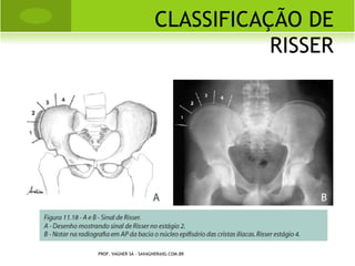 ESPONDILÓLISE




PROF. VAGNER SÁ - SAVAGNER@IG.COM.BR
 