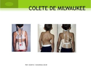 ESPONDILOLISTESE




PROF. VAGNER SÁ - SAVAGNER@IG.COM.BR
 