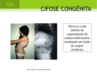 E PIFISIÓLISE    CABEÇA
                                                     FEMORAL


                                                   Epifisiolistese

                                                   Coxa-vara do
                                                    adolescente

                                                   Coxa vara
                                                    epifisária




PROF. VAGNER SÁ - SAVAGNER@IG.COM.BR
 