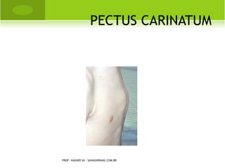 OSTEOSSARCOMA

   É um dos tumores ósseos mais malignos, atingindo adolescentes e
    adultos jovens na faixa etária preferencial entre 10 e 20 anos.

   Radiograficamente, são lesões predominantemente osteolíticas,
    destrutivas, bordas indistintas, com lesão da cortical, ruptura do
    periósteo e invasão de partes moles.

   A localização mais comum do osteossarcoma é na metáfise
    superior da tíbia e úmero e na metáfise inferior do fêmur e rádio,
    com predomínio ao redor do joelho.




                 PROF. VAGNER SÁ - SAVAGNER@IG.COM.BR
 