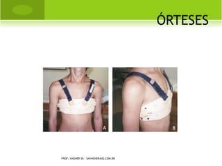 OSTEOSSARCOMA




PROF. VAGNER SÁ - SAVAGNER@IG.COM.BR
 