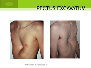 CONDROSSARCOMA

   É uma lesão que atinge o tecido cartilaginoso, região metafisária ou
    diafisária, maligna, que ocorre primariamente no adulto e
    raramente é encontrada na adolescência e na infância.

   Radiograficamente, o condrossarcoma primário evidencia
    espessamento de cortical, irregularidades e ondulações endostais e
    o aparecimento de calcificações algodonosas.

Tratamento

   O tratamento de escolha é cirúrgico com ressecção. As chances de
    recidiva são grandes, razão pela qual as margens de ressecção
    devem ser amplas.

   Não responde à quimioterapia e à radioterapia.
                  PROF. VAGNER SÁ - SAVAGNER@IG.COM.BR
 