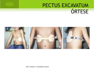 CONDROSSARCOMA




PROF. VAGNER SÁ - SAVAGNER@IG.COM.BR
 