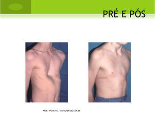 OSTEOCONDROMA




   É o tumor benigno mais comum, aproximadamente 10% de todos
    os tumores ósseos e 30% dos benignos. O osteocondroma é uma
    exostose óssea, coberta por uma camada de cartilagem. A
    localização é metafisária, principalmente ao redor do joelho,
    metáfise proximal do úmero e do fêmur.
                 PROF. VAGNER SÁ - SAVAGNER@IG.COM.BR
 