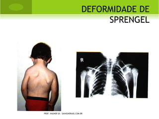    ENTORSE: lesão aguda do ligamento,
    causando perda temporária da
    congruência articular, causado por
    trauma indireto.
    Grau I  não há ruptura, apenas um
    esgarçamento.
    Grau II  ruptura parcial.
    Grau III  ruptura total.
     PROF. VAGNER SÁ - SAVAGNER@IG.COM.BR
 