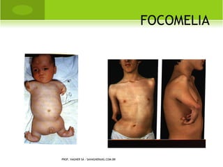 M ECANISMOS DE E NTORSE




PROF. VAGNER SÁ - SAVAGNER@IG.COM.BR
 