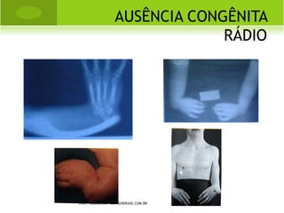    LUXAÇÃO: perda definitiva ou permanente
    da congruência articular, causado por
    trauma indireto. A luxação exige uma
    manobra de redução para restaurar
    anatomicamente uma articulação através
    de manobras técnicas utilizadas por
    profissionais habilitados.


    Redução incruenta: redução fechada.
    Redução cruenta: redução aberta ou
    cirúrgica.

    PROF. VAGNER SÁ - SAVAGNER@IG.COM.BR
 