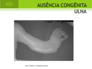 L UXAÇÃO TRAUMÁTICA




PROF. VAGNER SÁ - SAVAGNER@IG.COM.BR
 