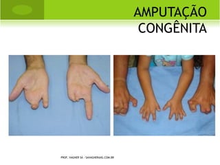 L UXAÇÃO PATELA




PROF. VAGNER SÁ - SAVAGNER@IG.COM.BR
 