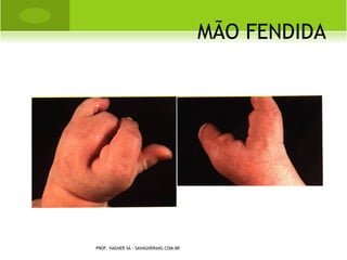 L UXAÇÃO O MBRO




PROF. VAGNER SÁ - SAVAGNER@IG.COM.BR
 