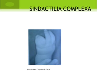 L UXAÇÃO A CRÔMIO -
                                              C LAVICULAR




PROF. VAGNER SÁ - SAVAGNER@IG.COM.BR
 