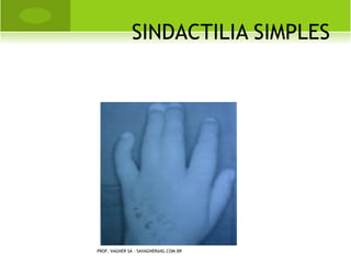L ESÕES M ÚSCULO -
                                            E SQUELÉTICAS

       DISTENSÃO: Indica que houve algum grau
        de ruptura nas fibras musculares, na
        junção músculo-tendão. Alongamento
        excessivo, excesso de exercício, excesso
        de uso do tecido mole, podem ser causas
        de distensão; tende a ser menos grave
        que uma entorse. Ocorre devido a
        trauma leve ou traumas não usuais
        repetidos de grau mínimo.

PROF. VAGNER SÁ - SAVAGNER@IG.COM.BR
 
