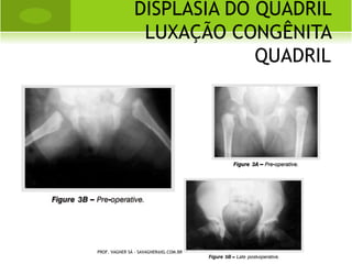    TENOSINOVITE: É uma inflamação da
    bainha sinovial que cobre um tendão.
   TENDINITE: É a inflamação de um tendão;
    pode ocorrer a formação de cicatriz ou
    deposição de cálcio em um tendão.
   TENOVAGINITE: É uma inflamação com
    espessamento da bainha tendínea.
   TENDINOSE: É uma degeneração do tendão
    devido a microtraumas repetitivos.
    PROF. VAGNER SÁ - SAVAGNER@IG.COM.BR
 