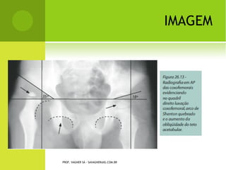 T ENDINITE CALCÁRIA




PROF. VAGNER SÁ - SAVAGNER@IG.COM.BR
 