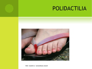 BURSITES


       Processo inflamatório que acomete
        a bolsa sinovial de algumas
        articulações e provoca dor e
        impotência funcional. Dentre elas,
        destacam-se a bursite subacromial,
        a bursite subcutânea do olécrano, a
        bursite patelar (rotuliana) e a
        bursite trocantérica.
PROF. VAGNER SÁ - SAVAGNER@IG.COM.BR
 