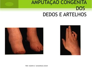 FRATURAS




PROF. VAGNER SÁ - SAVAGNER@IG.COM.BR
 