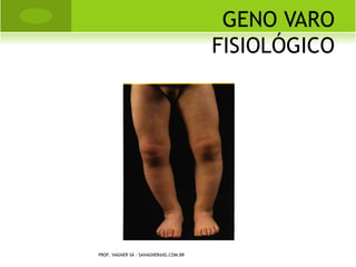 CLASSIFICAÇÃO


Traumatismo direto:
  Fraturas por impacto: ocorre quando uma força é
   aplicada em uma pequena área. A maior parte da
   energia é absorvida pelo osso, havendo pouca lesão
   de partes moles. Ex. chute e golpe com cassetete.
 Fraturas por esmagamento: apresentam extensa lesão
    de partes moles. O osso fica extensamente
    fragmentado ou fraturado transversalmente.
 Fraturas penetrantes (PAF): as feridas de alta
  velocidade dos rifles e fuzis, levam a extensas lesões
  de partes moles e fragmentos do osso.


            PROF. VAGNER SÁ - SAVAGNER@IG.COM.BR
 