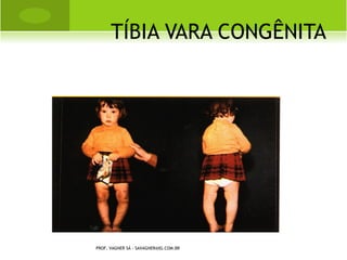 Traumatismo indireto:
       Fraturas por angulação: produz uma linha de fratura
    transversa com presença ou não de um fragmento
    triangular no seu lado côncavo.
       Fraturas por tração ou tensão: produz uma linha de
    fratura transversal. Ex. patela, olécrano, maléolo tibial.
         Fraturas rotacionais: produz uma linha de fratura
    espiral que faz uma rotação completa no osso.
        Fraturas por compressão: a diáfise dura de um osso
    longo é impulsionada para dentro da extremidade
    esponjosa, dando origem a fratura em forma de T ou V.
    Ex. extremidade inferior de úmero ou fêmur.
        Fraturas devido a angulação, rotação e compressão
    axial: produz uma linha de tração oblíqua.
              PROF. VAGNER SÁ - SAVAGNER@IG.COM.BR
 