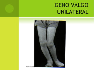 Q UANTO                             AO ESTADO DO OSSO



       Traumática: o osso estava em condições de
        normalidade estrutural.


       Patológica: o osso estava previamente
        afetado    por    uma     patologia. Ex.
        osteoporose, osteomielite, tumor.



    PROF. VAGNER SÁ - SAVAGNER@IG.COM.BR
 