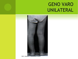 Q UANTO               AO NÚMERO DE
                                                     FRAGMENTOS

   Simples / Cominutiva




             PROF. VAGNER SÁ - SAVAGNER@IG.COM.BR
 