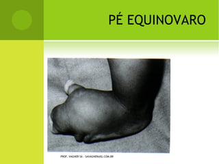 Q UANTO             À LOCALIZAÇÃO



       Ossos longos: epífise, diáfise e metáfise
       Ossos curtos e irregulares: citar o acidente
        anatômico envolvido. Ex. fratura do colo do
        escafóide.
Fraturas com nomes especiais: ex. fratura de
    Colles, Bennett, etc.




PROF. VAGNER SÁ - SAVAGNER@IG.COM.BR
 
