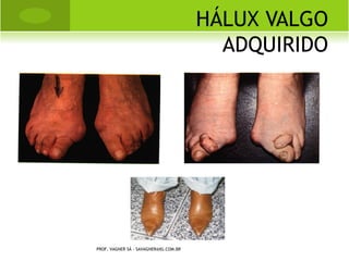 FRATURA OBSTÉTRICA
                      CLAVÍCULA

DIAGNÓSTICO:



 história (parto complicado - uso de fórceps, vácuo,
   etc.)

 tumefação discreta

 crepitação à palpação

 radiografia simples em ap

PROF. VAGNER SÁ - SAVAGNER@IG.COM.BR
 