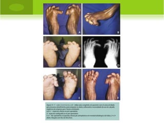 FRATURA DA CLAVÍCULA


LOCAIS MAIS FREQUENTES:
     a) segmento distal – próximo ao ligamento
      coracoacromial – 15 a 20%
       b) segmento intermediário – 75 a 80 %
       c) segmento proximal – 5%
POSICIONAMENTO DOS FRAGMENTOS                   NA
   FRATURA INTERMEDIÁRIA:
     a) fragmento distal sofre depressão
       b) fragmento proximal sofre elevação

PROF. VAGNER SÁ - SAVAGNER@IG.COM.BR
 