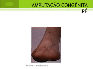TRATAMENTO
                                                     ORTOPÉDICO
bandagem de velpeau (ataduras elásticas) de 1 a 2 semanas.

obs.: verificar se há comprometimento do plexo braquial através
   do teste de moro.




              PROF. VAGNER SÁ - SAVAGNER@IG.COM.BR
 