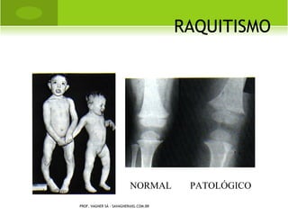 L ESÃO NERVOSA ASSOCIADA




PROF. VAGNER SÁ - SAVAGNER@IG.COM.BR
 