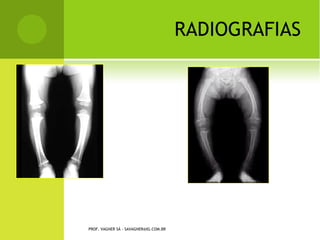 D EFORMIDADE COTOVELO




PROF. VAGNER SÁ - SAVAGNER@IG.COM.BR
 