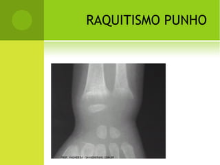 F RATURA - LUXAÇÃO
                                               COTOVELO




PROF. VAGNER SÁ - SAVAGNER@IG.COM.BR
 