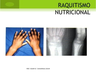 F RATURA -L UXAÇÃO
                                                 G ALEAZZI




PROF. VAGNER SÁ - SAVAGNER@IG.COM.BR
 