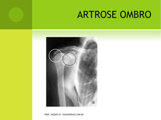 Tendões dos músculos grácil e
                               semitendíneo - confecção do
                               enxerto de tendões flexores.




                     Tendões flexores já retirados. Ainda
                     serão submetidos a limpeza e sutura
                     para confecção do enxerto
                     quádruplo.


PROF. VAGNER SÁ - SAVAGNER@IG.COM.BR
 