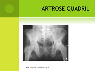 Parafuso transverso de titânio -
                           Transfix. Note que seu
                           posicionamento é perpendicular ao
                           do enxerto.




                        Parafuso de interferência absorvível
                        para fixação tibial - Extra-lock.




PROF. VAGNER SÁ - SAVAGNER@IG.COM.BR
 