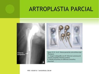 Posicionamento do parafuso no
                        túnel tibial. Note que após
                        traçãomanual, o parafuso é
                        implantado paralelo ao tendão.




                      Imagem que mostra feridas
                      cirúrgicas sob síntese com
                      mononylon. Note que não há mais
                      incisão cirúrgica mediana anterior.



PROF. VAGNER SÁ - SAVAGNER@IGhttp://ortopediasemlimites.blogspot.com/2007_09_01_archive.html
                             .COM.BR
 