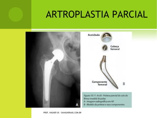 L ESÕES NOS M ENISCOS

   Lesões comuns

   Dor, falseio e travamento
    do joelho em flexão.

   Tratamento com técnicas
    de prevenção dos
    meniscos.

   Cirurgia em último caso.




                      PROF. VAGNER SÁ - SAVAGNER@IG.COM.BR
 