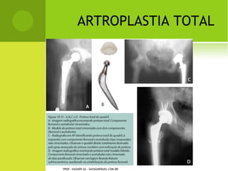 L ESÕES NOS M ENISCOS

   Risco de efusão e
    hemartrose.

   Correção cirúrgica com
    artroscopia.

   Fisioterapia pré e pós-
    cirurgia.

   Tempo de retorno médio
    para as lesões: 4 semanas.




PROF. VAGNER SÁ - SAVAGNER@IG.COM.BR
 