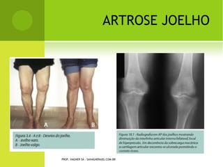 Momento em que, após a
manipulação intra-articular por
vídeo do menisco lesado (tipo alça
de balde), estamos realizando a
exérese do fragmento lesado.




Todo o procedimento é realizado
com visualização pelo vídeo.




                   PROF. VAGNER SÁ - SAVAGNER@IG.COM.BR
 