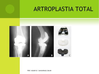 Note o grande fragmento retirada,
                            que estava dobrada sobre si mesmo,
                            travando de forma importante o
                            joelho do paciente, tornando
                            impossível sua extensão completa.




                              Imagem final do procedimento.
                              Note o discreto edema residual e os
                              portais sintetizados com apenas um
                              ponto (0,5 cm).
                            http://ortopediasemlimites.blogspot.com/2007_09_01_archive.html




PROF. VAGNER SÁ - SAVAGNER@IG.COM.BR
 