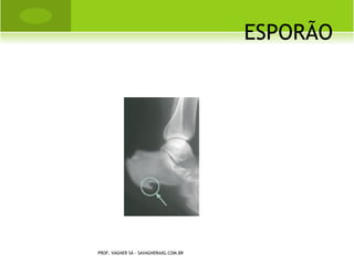 M ENISCO DISCÓIDE




PROF. VAGNER SÁ - SAVAGNER@IG.COM.BR
 