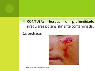     CONTUSA: bordas e profundidade
     irregulares,potencialmente contaminada.
Ex. pedrada.




    PROF. VAGNER SÁ - SAVAGNER@IG.COM.BR
 