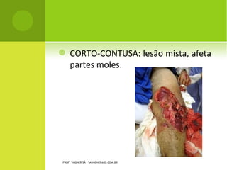     CORTO-CONTUSA: lesão mista, afeta
     partes moles.




PROF. VAGNER SÁ - SAVAGNER@IG.COM.BR
 