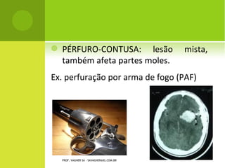    PÉRFURO-CONTUSA: lesão                 mista,
    também afeta partes moles.
Ex. perfuração por arma de fogo (PAF)




    PROF. VAGNER SÁ - SAVAGNER@IG.COM.BR
 
