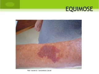 HEMATOMA




PROF. VAGNER SÁ - SAVAGNER@IG.COM.BR
 