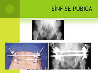 O STEOGÊNESE I MPERFEITA




PROF. VAGNER SÁ - SAVAGNER@IG.COM.BR
 