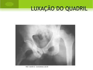 T RATAMENTO


       Tratamento medicamentoso: na
        tentativa de se obter um aumento
        na resistência óssea, porém sem ser
        específica para resultados
        absolutos.
       Prevenção das fraturas
       Fisioterapia e terapia ocupacional
PROF. VAGNER SÁ - SAVAGNER@IG.COM.BR
 