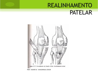 TORCICOLO M USCULAR
                                       CONGÊNITO




PROF. VAGNER SÁ - SAVAGNER@IG.COM.BR
 