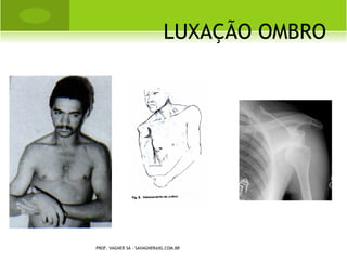 T RATAMENTO                    CONSERVADOR


   Fisioterapia com 3 semanas de idade;
   Alongamento ECOM
   Fortalecimento ECOM contra-lateral
   Alinhamento da cabeça
   Adotar postura contra-lateral para
    dormir
   Orientações aos pais
    PROF. VAGNER SÁ - SAVAGNER@IG.COM.BR
 