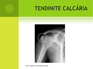 E SCOLIOSE   POR
                                       N EUROFIBROMATOSE




PROF. VAGNER SÁ - SAVAGNER@IG.COM.BR
 