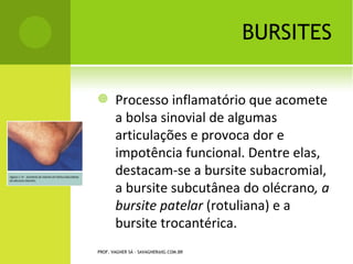 E SCOLIOSE C ONGÊNITA

                                       Curva congênita de
                                       ângulo agudo e
                                       rígido,   com      o
                                       tronco encurtado e
                                       deformidades      da
                                       caixa torácica, com
                                       corcova       costal
                                       proeminente.



PROF. VAGNER SÁ - SAVAGNER@IG.COM.BR
 